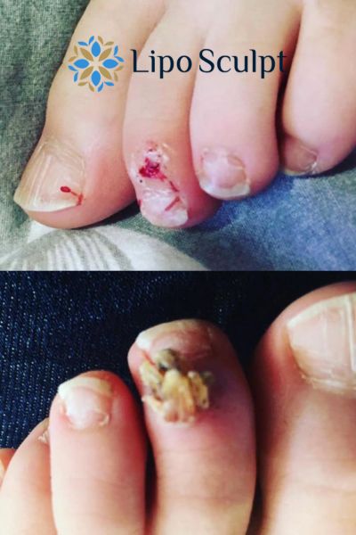 Wart removal customer results from Lipo Sculpt Buxton