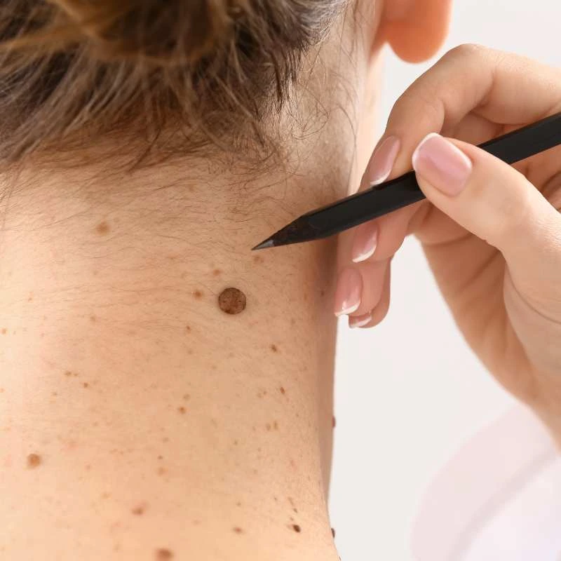 See our lesion removal prices Buxton - call today for a free quote